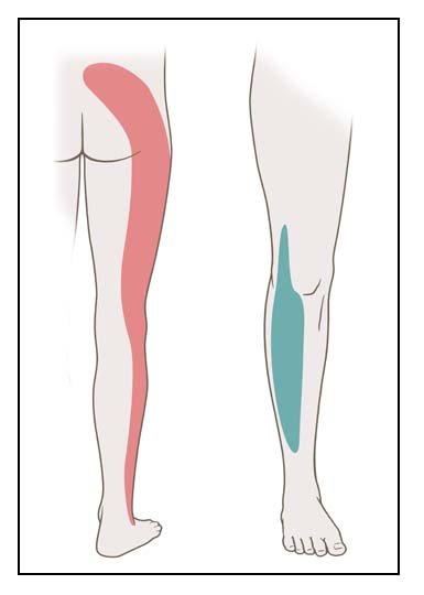 The illustration shows where sciatica symptoms can occur if you have a pinched nerve at the 5th lumbar vertebra.