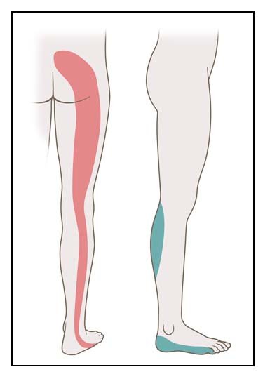 The illustration shows where sciatica symptoms can occur if you have a pinched nerve at the sacrum.