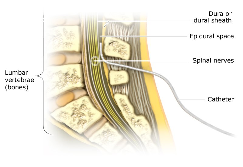 Illustration: Epidural catheter - as described in the article