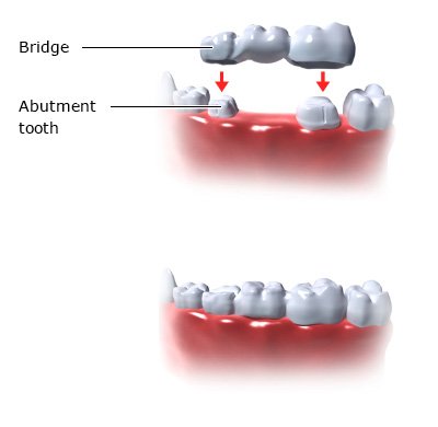 Illustration: Bridge - as described in the article