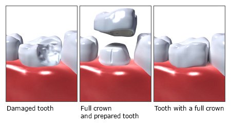 Illustration: Full crown - as described in the article