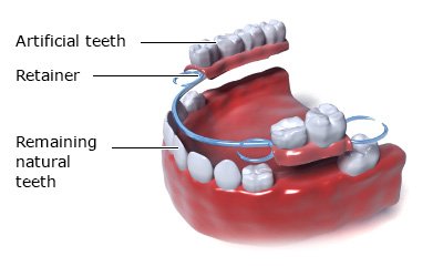 Illustration: Partial dentures for the lower jaw - as described in the article