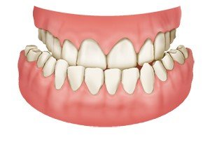 Illustration: Crossbite on both sides of the mouth – the back teeth don’t touch when biting