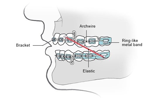 Illustration: Fixed braces with glued-on brackets