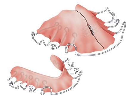 Illustration: Removable braces for the upper and lower jaw