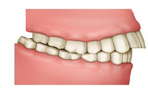 Illustration: Overbite with sticking-out upper front teeth