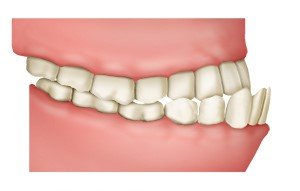 Illustration: Underbite with sticking-out lower front teeth