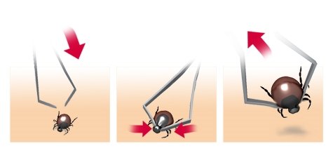 Illustration: Removal of a tick using tick tweezers – as described in the article