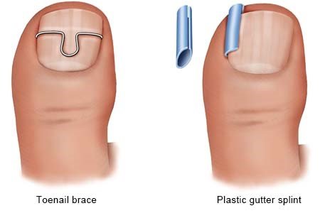 Illustration: Brace or splint as a treatment option - as described in the article