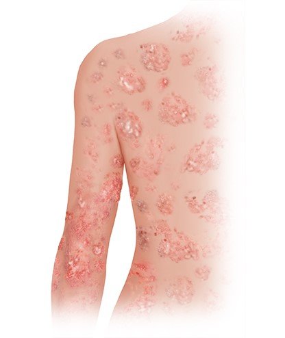 Illustration: Skin rash caused by celiac disease