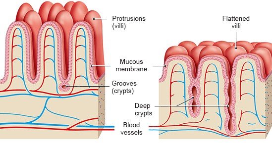 Illustration: Left – Healthy lining of the small intestine; Right – Damaged lining of the small intestine