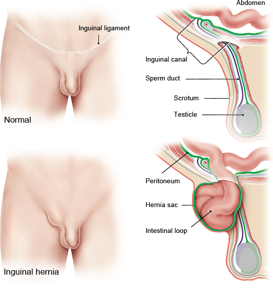 Inguinal (groin) hernias in men - Hernias - informedhealth.org