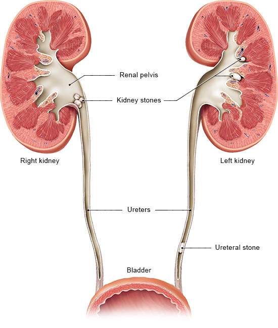 kidneystone图片
