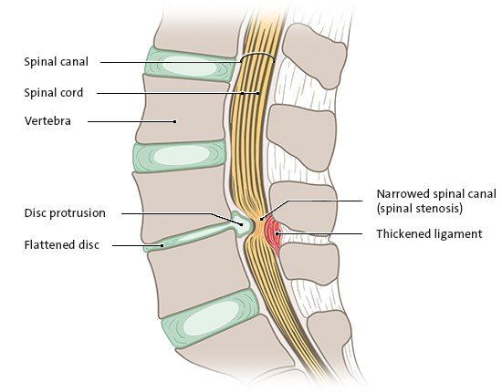 Illustration: Narrowed spinal canal, longitudinal section, view from side