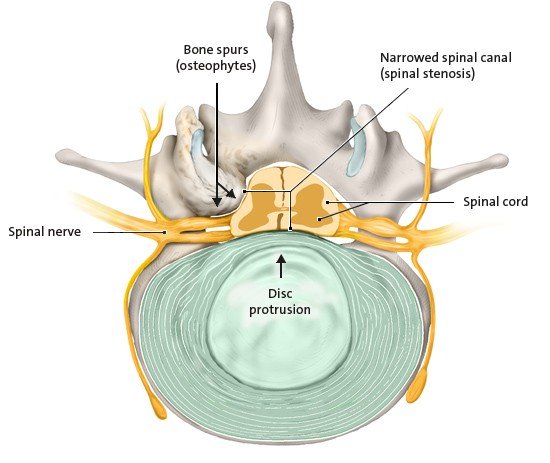 Illustration: Narrowed spinal canal, cross section, view from above